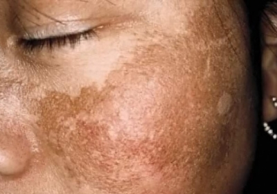 Melasma